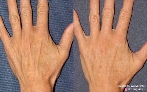 Hand re-volumization