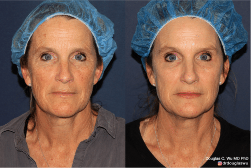 Sun damage treated with Picoway, VBeam, and FraxPro