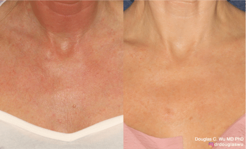 Chest sun damage treated with Picoway, VBeam, and FraxPro