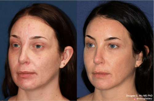 Laser resurfacing is one of the most effective ways to tighten the skin, remove wrinkling and fine lines that give a dull tired appearance.