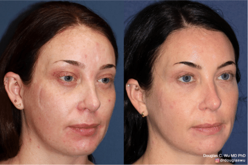 Laser resurfacing is one of the most effective ways to tighten the skin, remove wrinkling and fine lines that give a dull tired appearance.