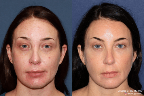 Laser resurfacing is one of the most effective ways to tighten the skin, remove wrinkling and fine lines that give a dull tired appearance.