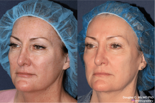 Laser resurfacing is one of the most effective ways to tighten the skin, remove wrinkling and fine lines that give a dull tired appearance.
