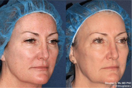 Laser resurfacing is one of the most effective ways to tighten the skin, remove wrinkling and fine lines that give a dull tired appearance.