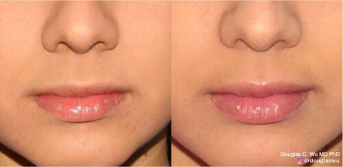 Natural lip volumization