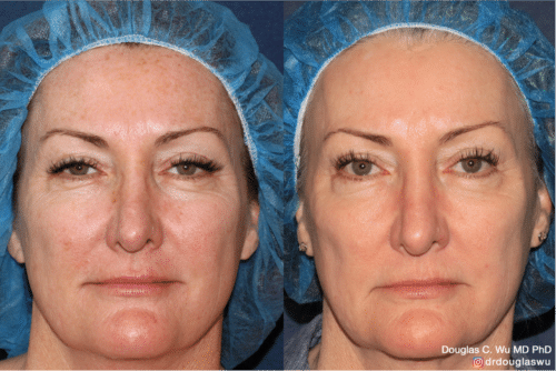 Laser resurfacing is one of the most effective ways to tighten the skin, remove wrinkling and fine lines that give a dull tired appearance.