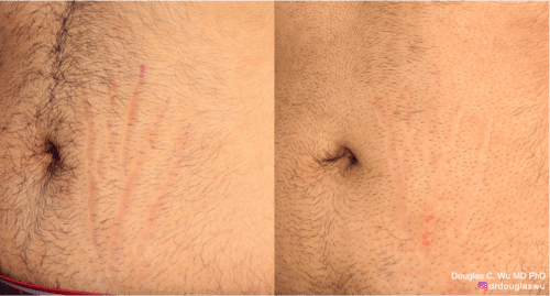 Picoway Vbeam to reduce the appearance of stretch marks