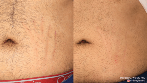 Picoway Vbeam to reduce the appearance of stretch marks
