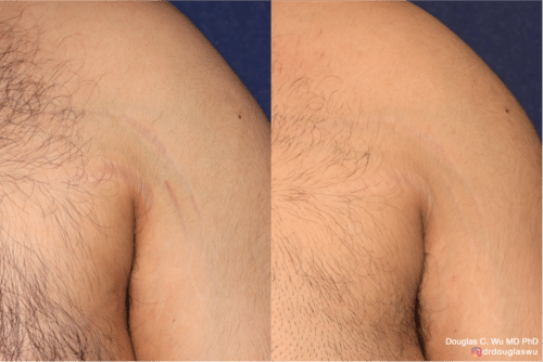 Picoway Vbeam to reduce the appearance of stretch marks