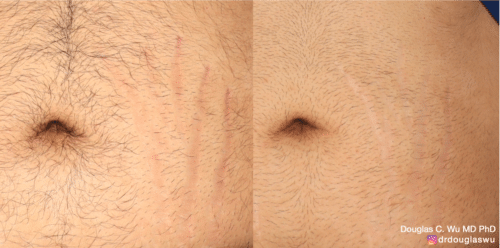 Picoway Vbeam to reduce the appearance of stretch marks