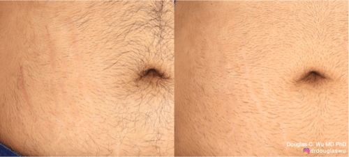 Picoway Vbeam to reduce the appearance of stretch marks