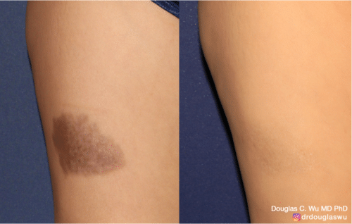 Iron injection staining removed by Picoway