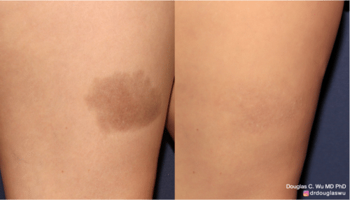 Iron injection staining removed by Picoway