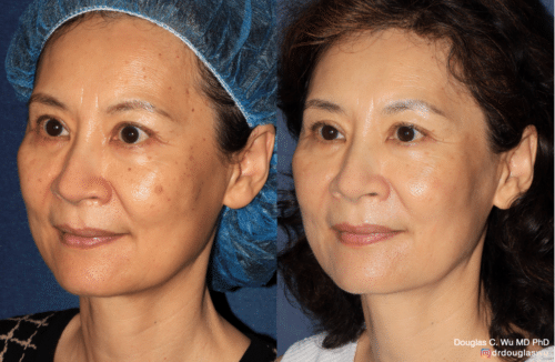 PicoClear for brown spots and brightening