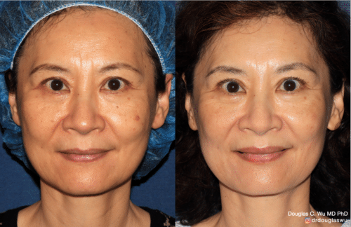 PicoClear for brown spots and brightening