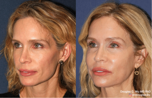 Customized maintenance treatment 10 years later