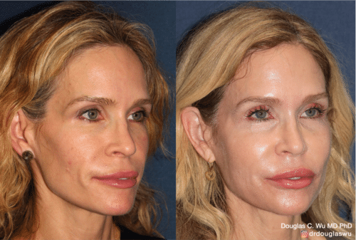 Customized maintenance treatment 10 years later