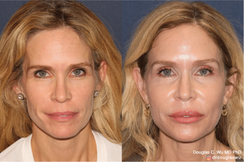 Customized maintenance treatment 10 years later