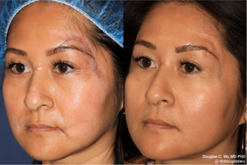 Traumatic Scar Removal