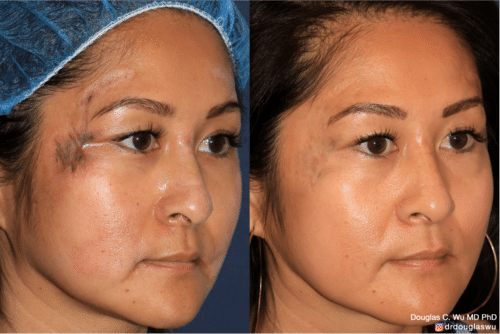 Traumatic Scar Removal