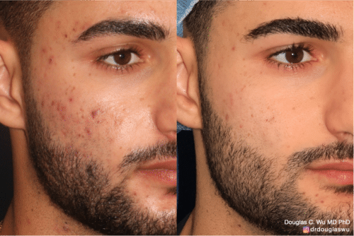 Acne and acne scar removal