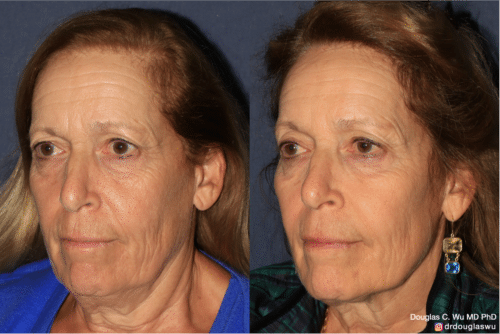 Customized maintenance treatment 5 years later