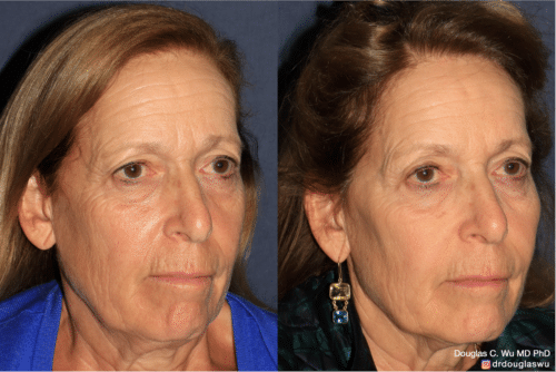 Customized maintenance treatment 5 years later