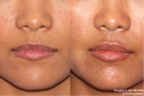 Natural lip volumization
