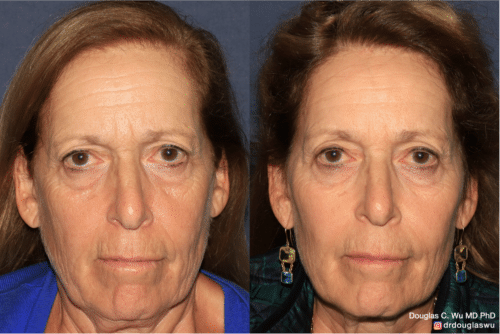 Customized maintenance treatment 5 years later