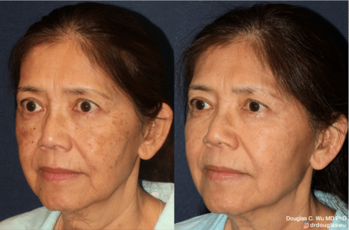PicoUltra Laser Resurfacing