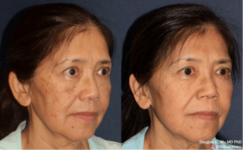 PicoUltra Laser Resurfacing