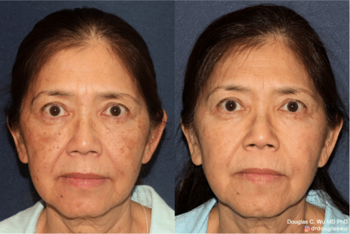 PicoUltra Laser Resurfacing