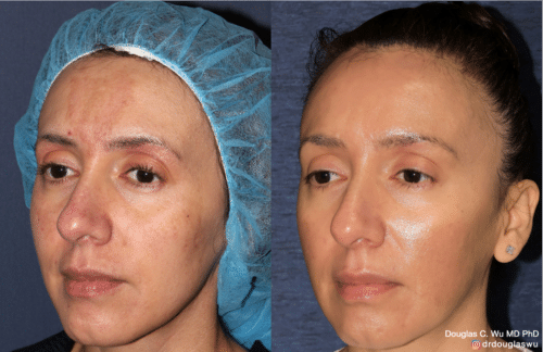 Customized maintenance treatment 10 years later