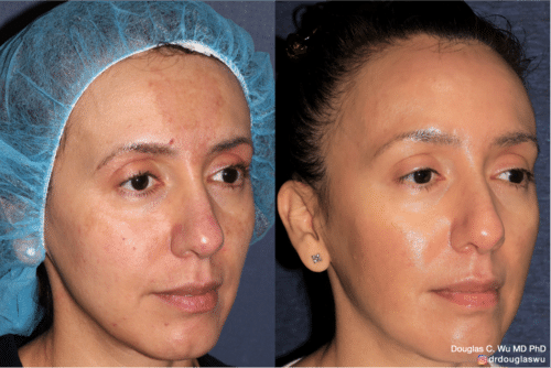 Customized maintenance treatment 10 years later