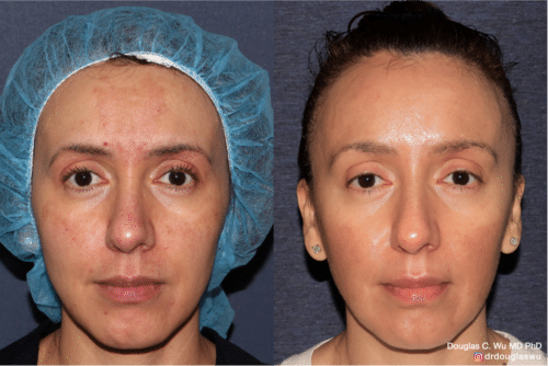 Customized maintenance treatment 10 years later