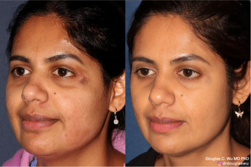 PicoClear for brightening skin tone and spot removal