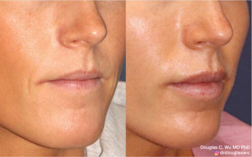 Natural lip volumization