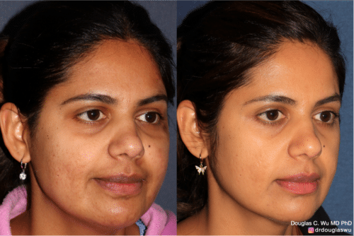 PicoClear for brightening skin tone and spot removal