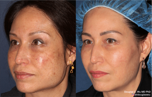 Customized maintenance treatment 10 years later