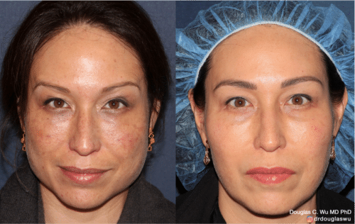 Customized maintenance treatment 10 years later