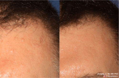 Removal of sebaceous hyperplasia