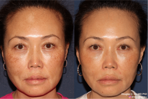 PicoClear for Melasma