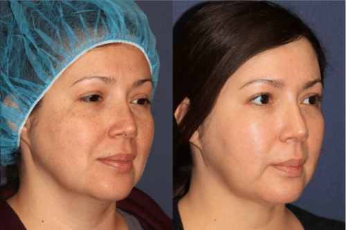 PicoUltra laser resurfacing to improve skin tone