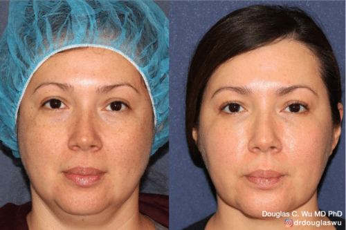 PicoUltra laser resurfacing to improve skin tone