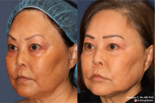 Customized maintenance treatment 10 years later