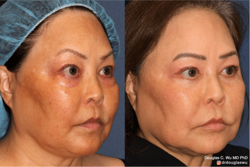 Customized maintenance treatment 10 years later