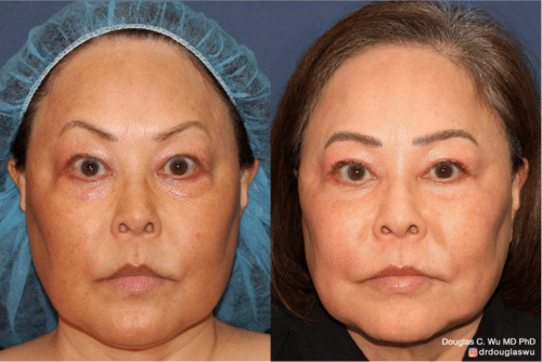 Customized maintenance treatment 10 years later