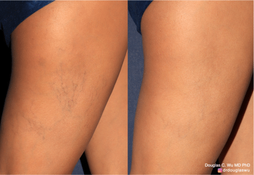 Sclerotherapy to improve the appearance of leg veins