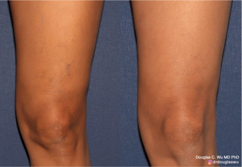 Sclerotherapy to improve the appearance of leg veins