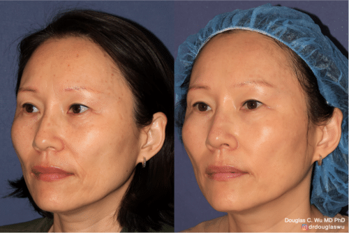 PicoTone laser resurfacing